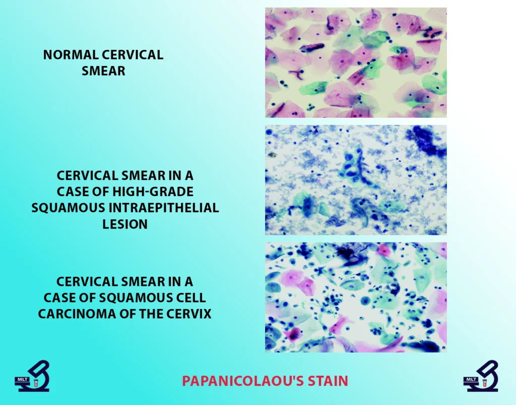 Papanicolaou's Stain